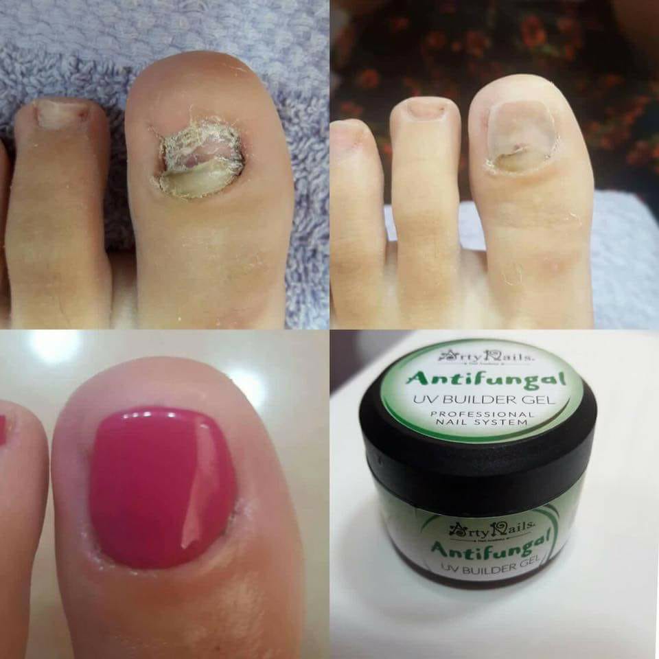 Foot Fungus Treatment For Toe Nail Foot Antifungal Agent Cuticle Oil Nail  Polish Remover Onychomycosis Medicine Foot Care Beauty | Fruugo BH